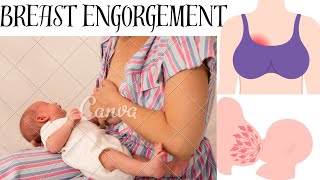 What is Breast engorgementBREAST COMPLlCATIONRetracted nippleAcute mastitisBreast abscess [upl. by Tiemroth787]