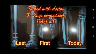 Visiting doctor after 116 days of Tibia Fibula Patella fracture  Xray Comparison How to walk [upl. by Mouldon]