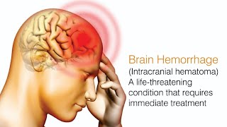 What is Brain Hemorrhage and its types l causes symptoms Treatment l [upl. by Catharina]