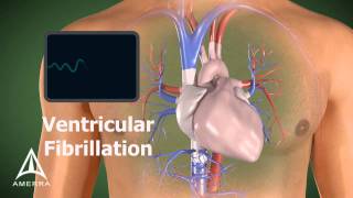 AED  3D Medical Animation [upl. by Bailey765]