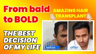 Unbelievable Hair Transplant Result 2024  Best Hair Transplant in Delhi 2024  MedLinks [upl. by Dalli]