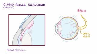 Glaucoma openangle closedangle and normaltension  pathology diagnosis treatment [upl. by Andromede]