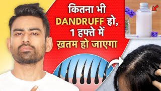 Dandruff का Permanent Solution at Home For Men amp Women [upl. by Slade]