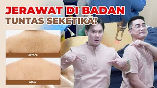 JERAWAT DI BADAN TUNTAS SEKETIKA [upl. by Leanard482]