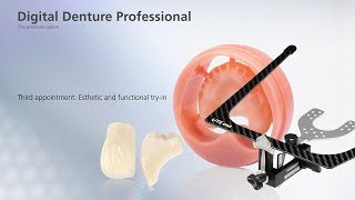 Digital Denture – third Appointment [upl. by Perr]