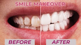 Total Mouth Restoration With Porcelain Veneers  Minimal Preparation Dental Boutique [upl. by Adiaj]