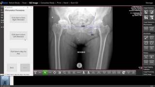 Radlink GPS Surgeons Checklist Software Demo Anterior Approach THA Pre Op [upl. by Belden751]