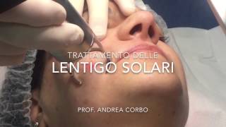 Lentigo Solari  Trattamento con Laser frazionato CO2 [upl. by Yerffe275]