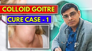 Colloid Goitre CURE Case No 1  Homeopathy Treatment for Colloid Goitre  Dr Abhik Ghosh [upl. by Kung]