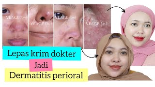 PERJUANGAN SEMBUH DARI DERMATITIS PERIORAL  Krim Etiket Biru  CREAM PEMUTIH  By Vapinka Makeup [upl. by Adey]