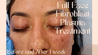 Fibroblast Plasma Skin Tightening Full Face before and aftersun spots acne scars etc [upl. by Jakie]