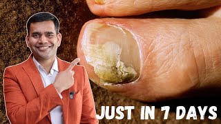 Just in 7 Days Cure Toenail Fungus At Home  Best Remedy For Toenail Fungus  Dr Vivek Joshi [upl. by Mclaughlin]