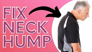 How You Can Get Rid of Neck Hump With a SOCK Dowagers Hump [upl. by Pedrick]