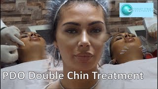 Get Rid of Double Chin PDO Thread Lift  Harley Street Treatment [upl. by Tedd]