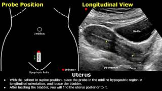 Uterus amp Ovaries Ultrasound Probe Positioning  Transducer Placement  Gynecological USG Scanning [upl. by Irac392]