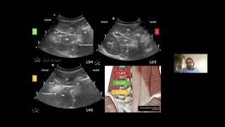 Psoaskompartmentblock  USGTechniken und Indikationen amp UltraschallUnterstützung bei der PDA [upl. by Accem]