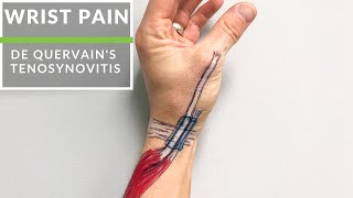 De Quervains Tenosynovitis [upl. by Card]