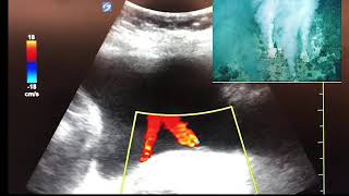 Ureteral Jets [upl. by Robison]