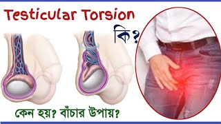 Testicular Torsion in bangla । অন্ডকোষে ব্যাথার কারন ও প্রতিকার। [upl. by Mosier]