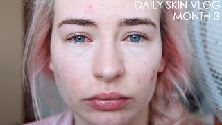 Roaccutane Daily Skin Vlog  Month 3 [upl. by Aicat524]