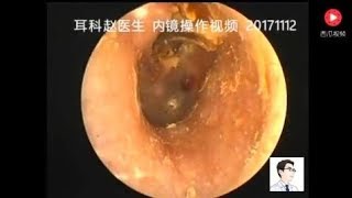 Earwax Removal ExtractionYou want to see an ear endoscope to clean up the middle ear cholesteatoma [upl. by Sema579]