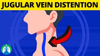 What is Jugular Venous Distention Medical Definition and Explanation [upl. by Meris462]