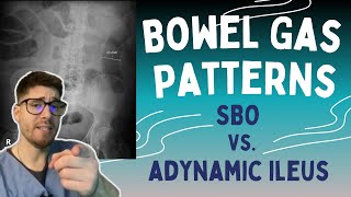 SBO vs Adynamic Ileus Learn the 369 rule to read bowel gas patterns on Xrays [upl. by Gnues32]