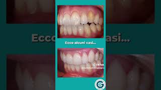 Casi risolti con Faccette dentali [upl. by Rist]