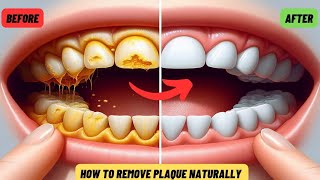 How To Remove Plaque From Teeth  Tartar Removal [upl. by Akcire]