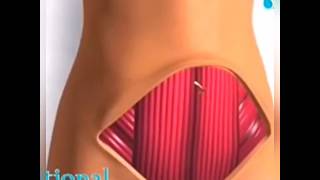 Dr Walid Balti  abdominoplastie  le geste chirurgical [upl. by Slavic]