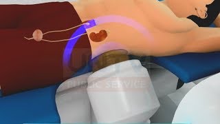 Kidney Stones Actual ESWL procedure [upl. by Yraek793]