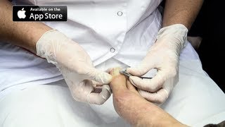 Ingrown Toenail Removal Surgery [upl. by Baiel]