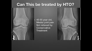 High Tibial Osteotomy  Misconceptions amp Planning [upl. by Foskett]