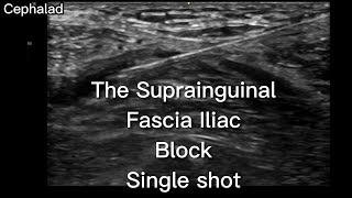 The Suprainguinal Fascia Iliac Block in the Emergency Department [upl. by Idnir]