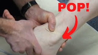 Peroneus longus subluxation How to treat it [upl. by Zebe]