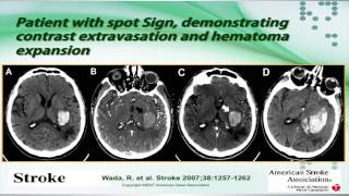 Intracerebral Hemorrhage by Sebastian Koch MD [upl. by Bruce823]