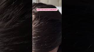 How I get rid of dandruff using a scalp massage brush [upl. by Marih]