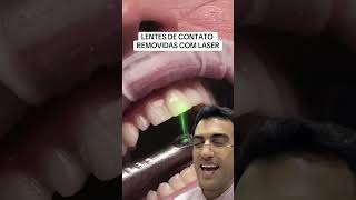 LASER REMOVENDO LENTES DE CONTATO [upl. by Crary]