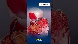 Face Transplant Surgery कैसे की जाती है 3D Explained shorts plasticsurgery [upl. by Garrick]