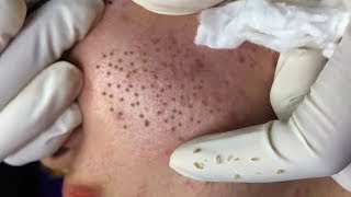 How To Remove Blackheads And Whiteheads On Face Easy 38 ✦ Dr Laelia ✦ [upl. by Yarb]