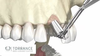 Torrance CA Bone Grafting for Dental Implants  Redondo Beach Tooth Bone Graft [upl. by Tegdirb]