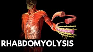 Rhabdomyolysis Unveiled From Muscle Damage to Kidney Risk [upl. by Treblah]