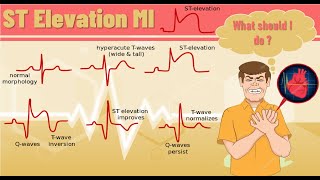 ST elevation myocardial infarction STEMI  ST elevation MI pathophysiology ECG finding and example [upl. by Aidnama]