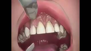 Gum Graft Dental Surgery [upl. by Lokim]