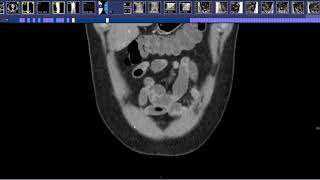 How to read a CT Enterography [upl. by Dripps]