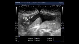 Anencephaly  a neural tube defect [upl. by Milson171]