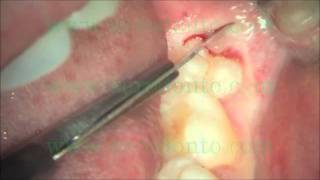 Dr Roberto Barone Dr Carlo Clauser Dr Angelo Baleani  Wisdom tooth surgical flap incision [upl. by Adnawal]