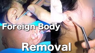 Removal of Foreign Body Stuck from Peoples Ears Compilation [upl. by Ennaira89]