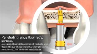 Sinus lifting amp Bone grafting with SLD2014  Autotome 2014  SSISLD anygraft의 사본 [upl. by Nolat64]