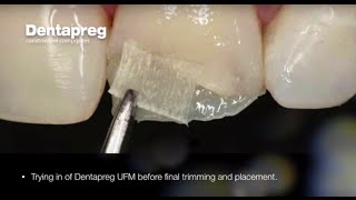 Restoration of Chipped Incisal Edge by Dr Dennis Hartlieb [upl. by Idnahc947]